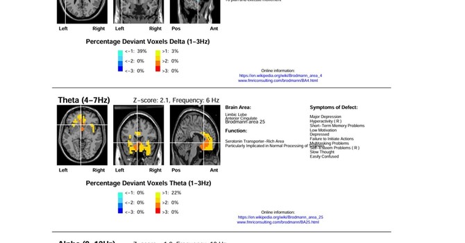 The Benefits of LORETA-Style qEEG:  image