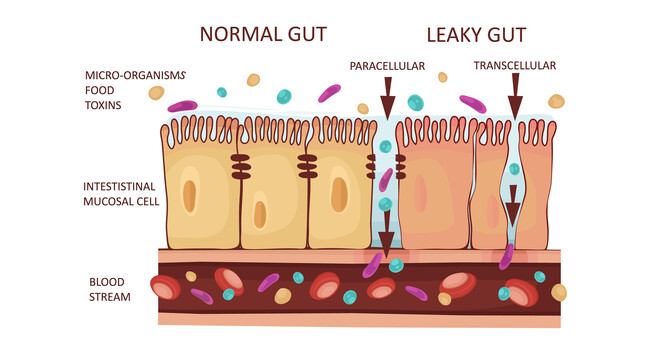 Leaky Gut Symptoms and Treatment with Functional Medicine in Saint Paul image
