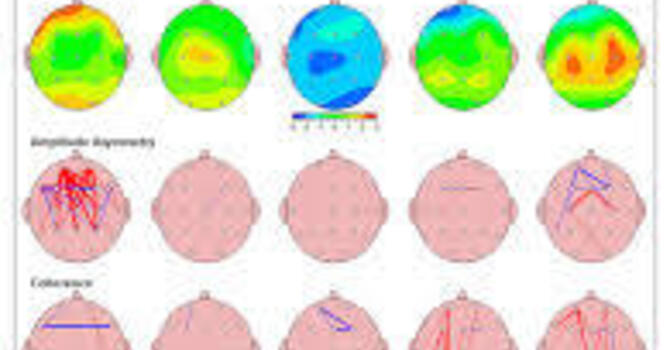 What Is a Quantitative Electroencephalogram qEEG?
